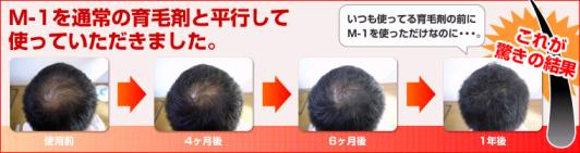 驚きの【M-1】の発毛・育毛効果!